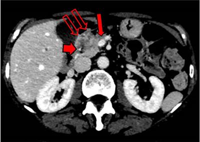 A Patient With Stage III Locally Advanced Pancreatic Adenocarcinoma Treated With Intra-Arterial Infusion FOLFIRINOX: Impressive Tumoral Response and Death due to Legionella pneumophila Infection: A Unique Case Report